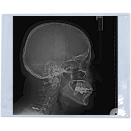 Mica para lateral de cráneo