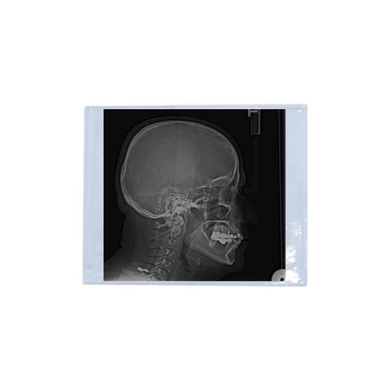 Mica para lateral de cráneo
