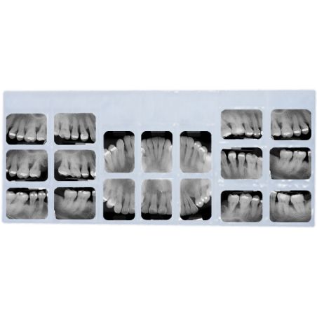 Mica para periapical