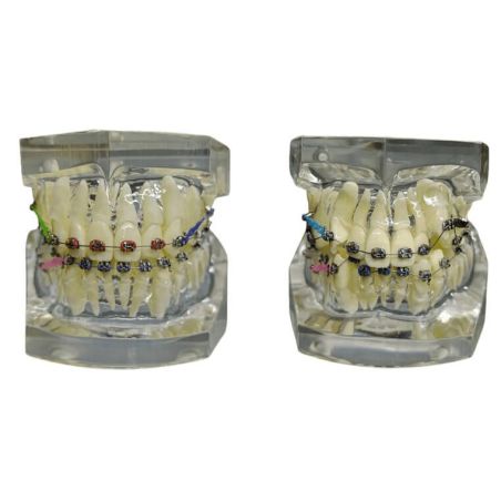 Tipodonto con brackets