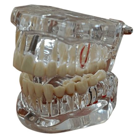 Tipodonto con patologías