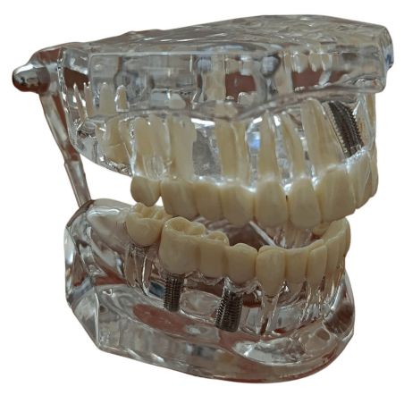 Tipodonto con patologías