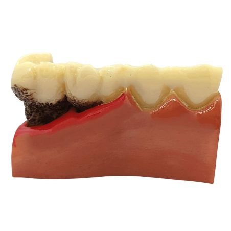 Periodontitis severa y frontal periodontis