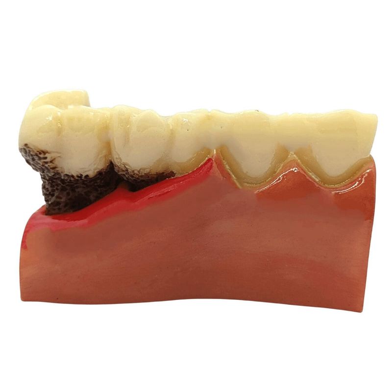 Periodontitis severa y frontal periodontis