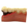 Periodontitis severa y frontal periodontis