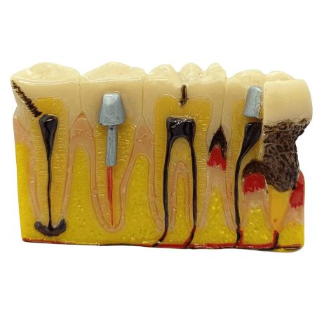 Periodontitis severa y frontal periodontis