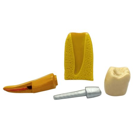 Restauración endoposte