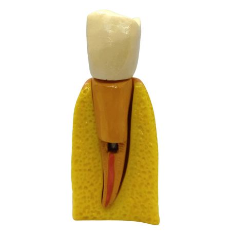 Restauración endoposte