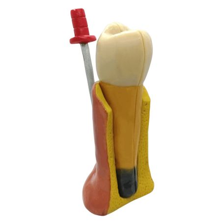 Tratamiento de endodoncia